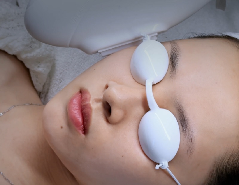laser trị mụn ở mặt