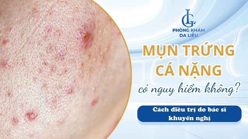 Mụn trứng cá nặng là gì?