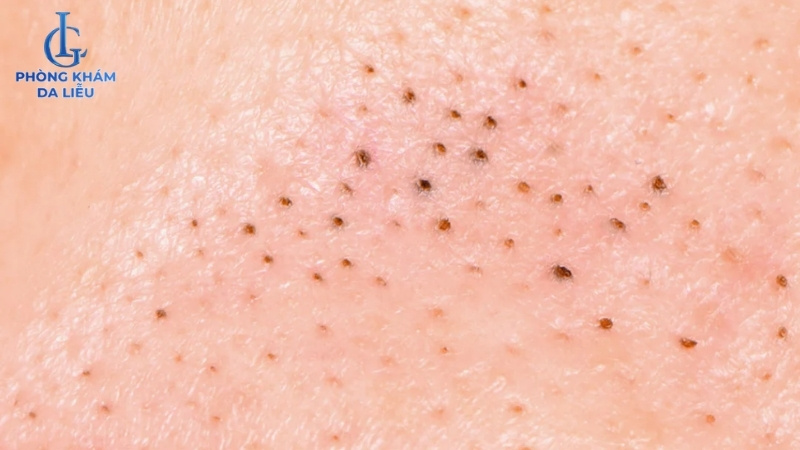 mụn trứng cá ở lưng dạng nhẹ đầu đen