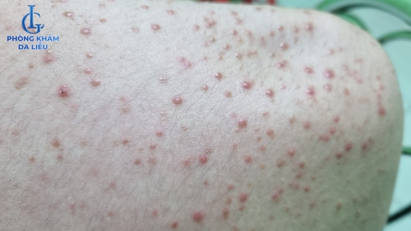 mụn trứng cá ở lưng là gì