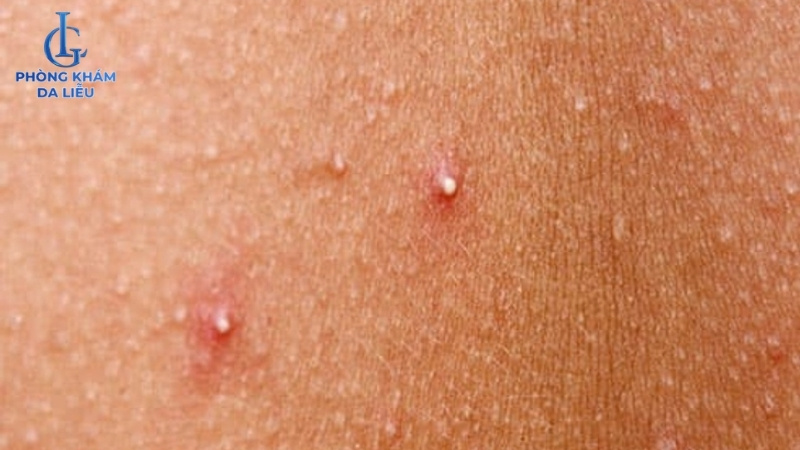 mụn trứng cá ở lưng nhẹ, đầu trắng