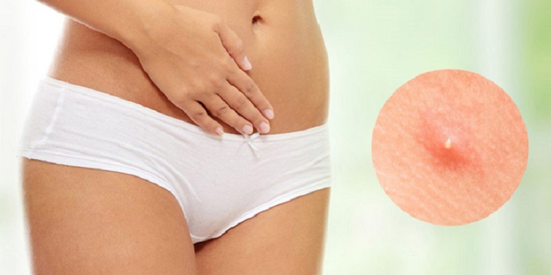 mọc mụn trứng cá ở vùng kín nữ