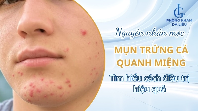Mụn trứng cá quanh miệng