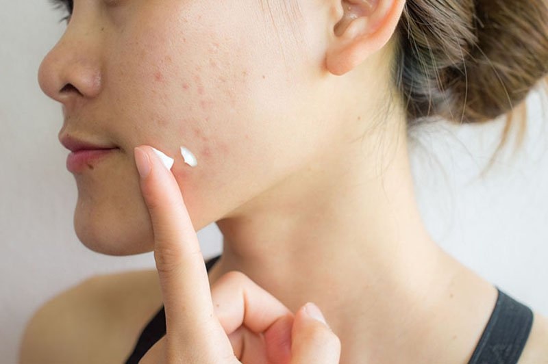 Sử dụng thuốc trị mụn trứng cá ung