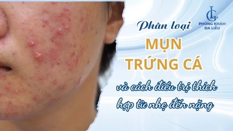 Mụn trứng cá