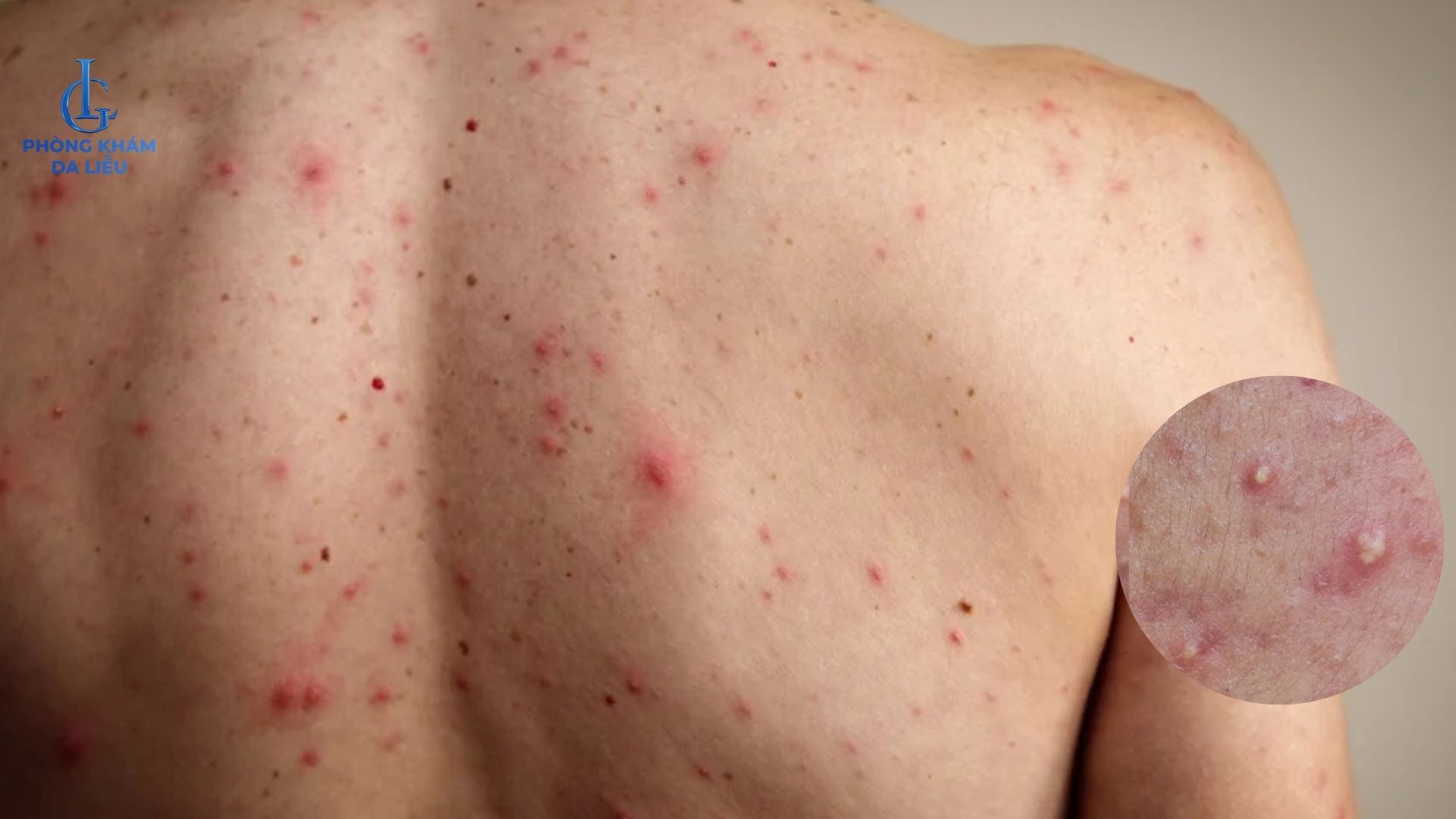 mụn mủ ở lưng