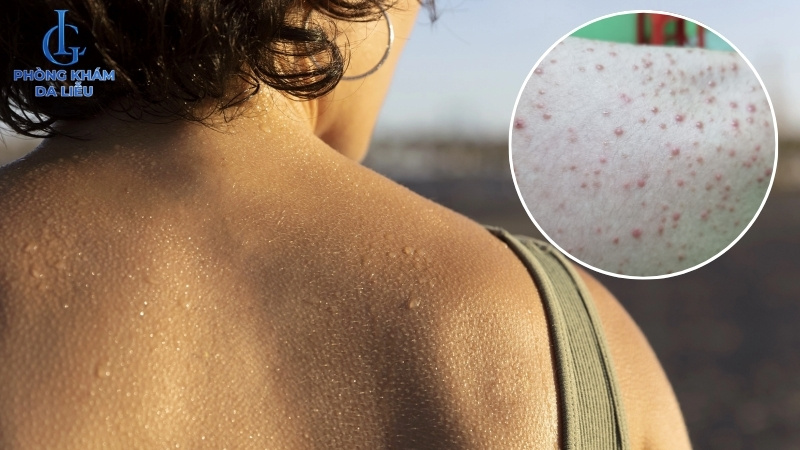 nguyên nhân gây mụn trứng cá ở lưng