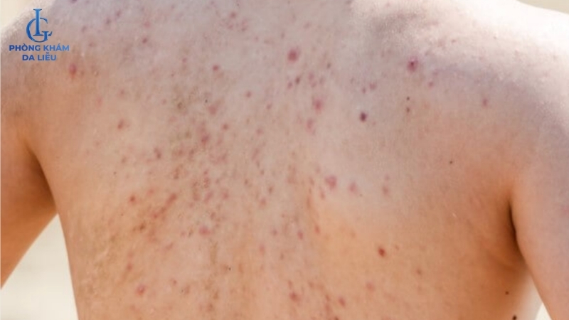 nguyên nhân nổi mụn lưng ở nam giới