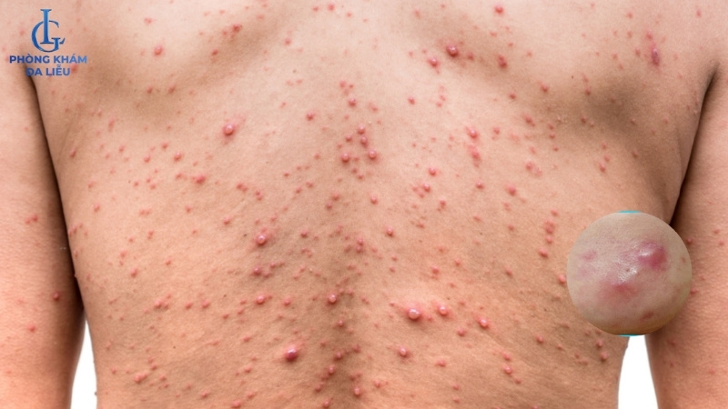 nổi mụn bọc ở lưng nam giới