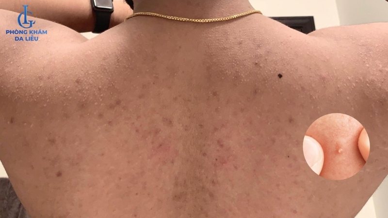 nổi mụn đầu trắng ở lưng nam giới