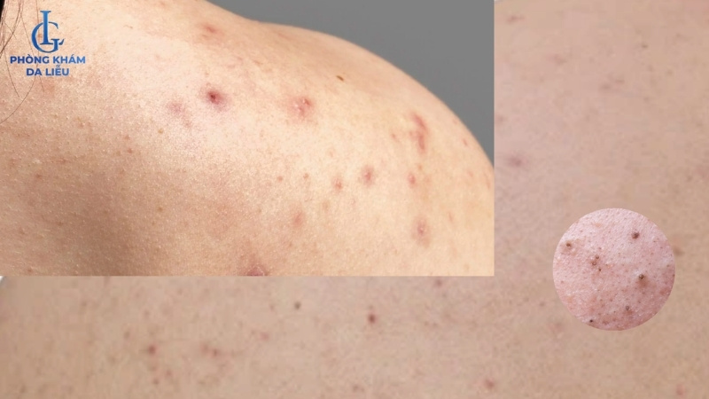 nổi mụn lưng ở nam giới