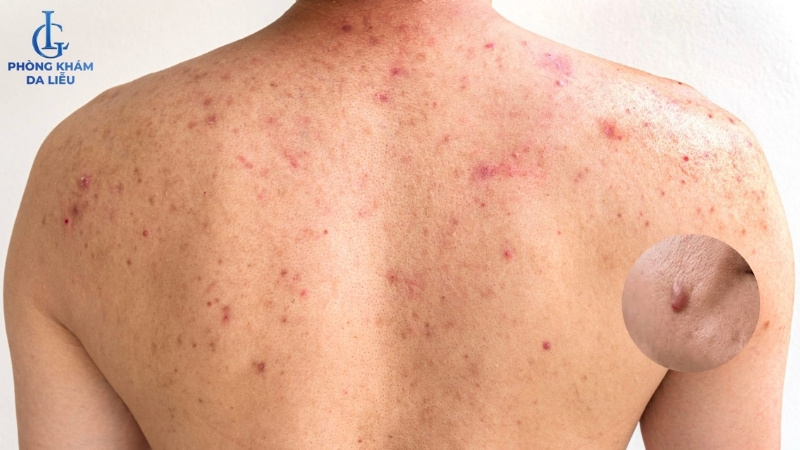 nổi mụn nang ở lưng nam gới