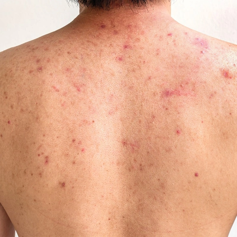 lưng nam giới với các nốt mụn đỏ