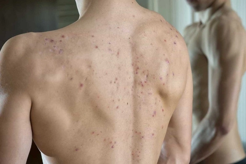 mụn lưng ở nam giới