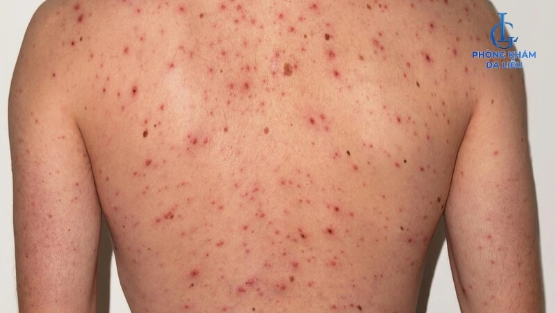 Phát ban mụn trứng cá ở lưng