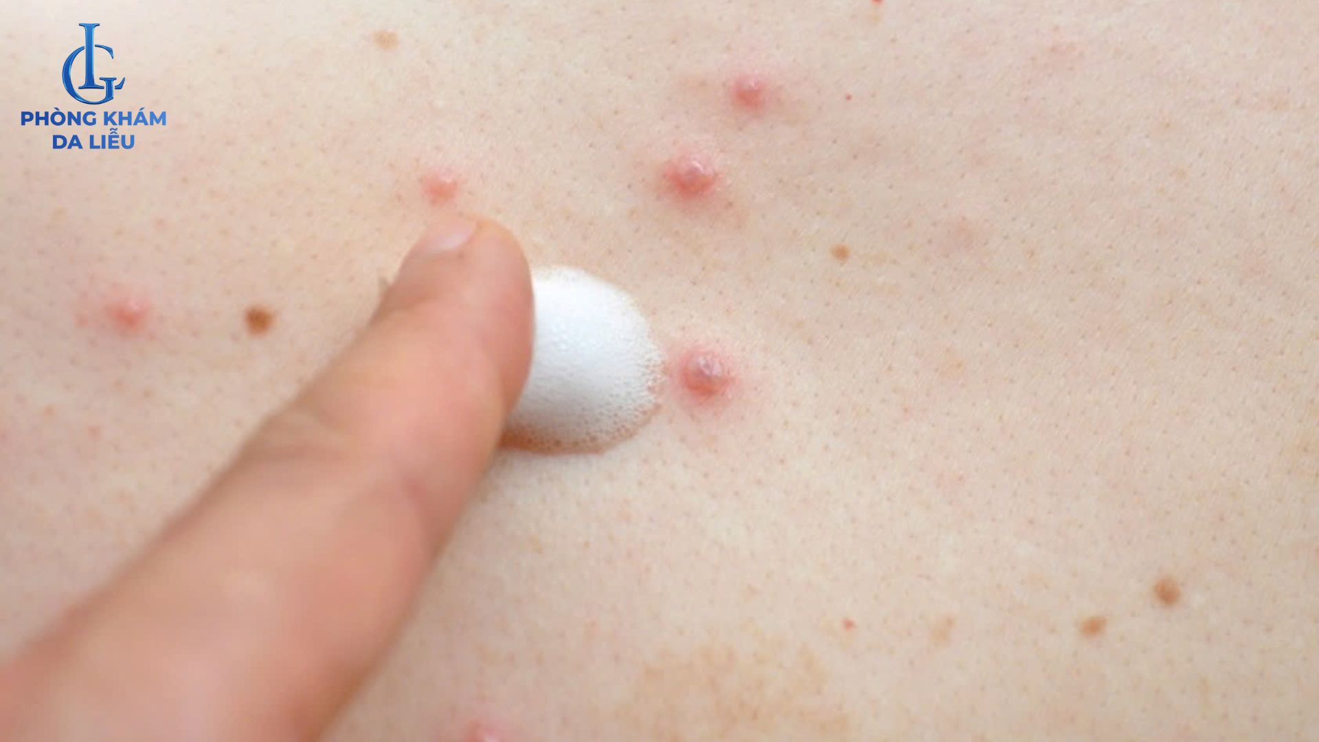 thuốc bôi trị mụn trứng cá lưng