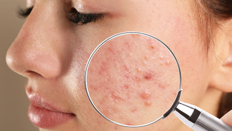 bị mụn trứng cá