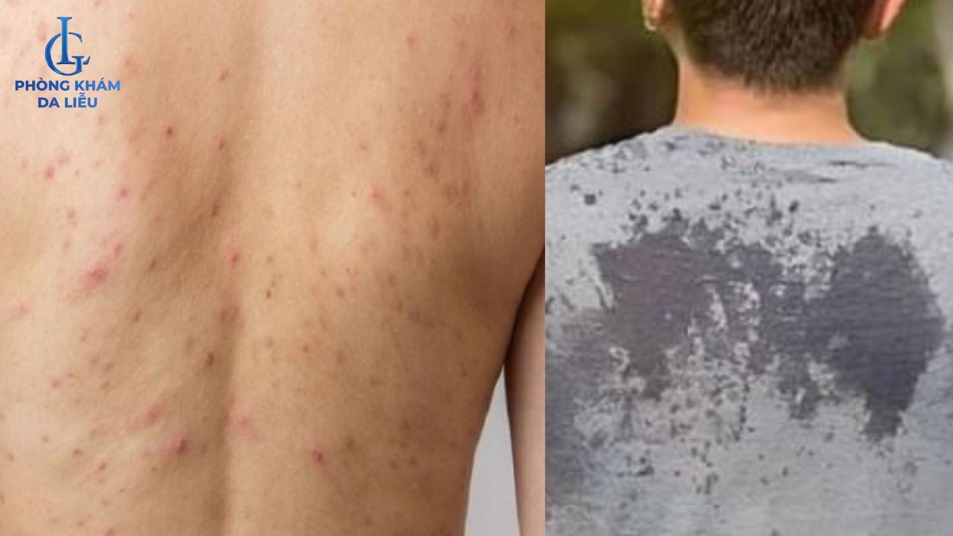 tích tụ mồ hôi gây mun