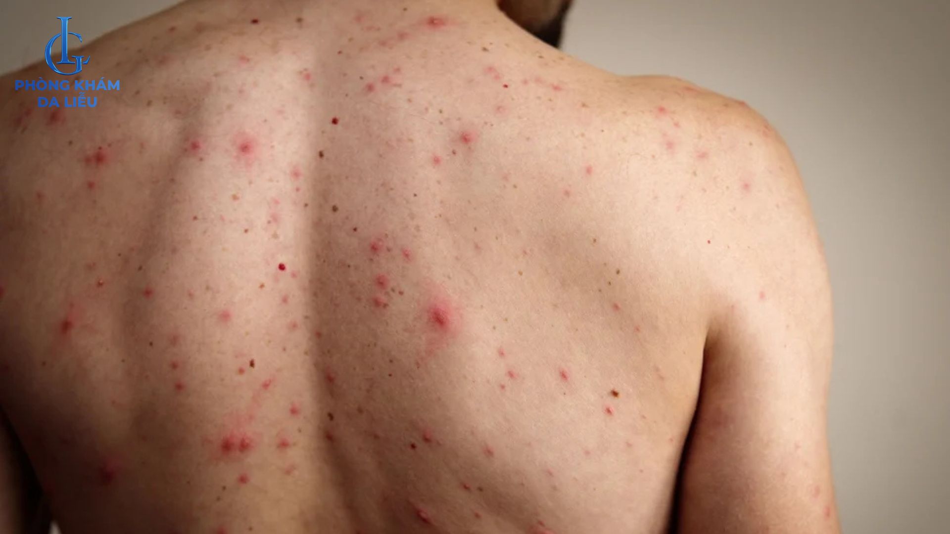 tình trạng viêm nang lông ở lưng