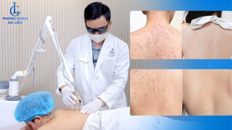 trị mụn lưng ở spa giá bao nhiêu tiền