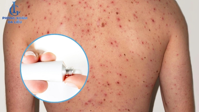 trị mụn trứng cá ở lưng bằng thuốc bôi