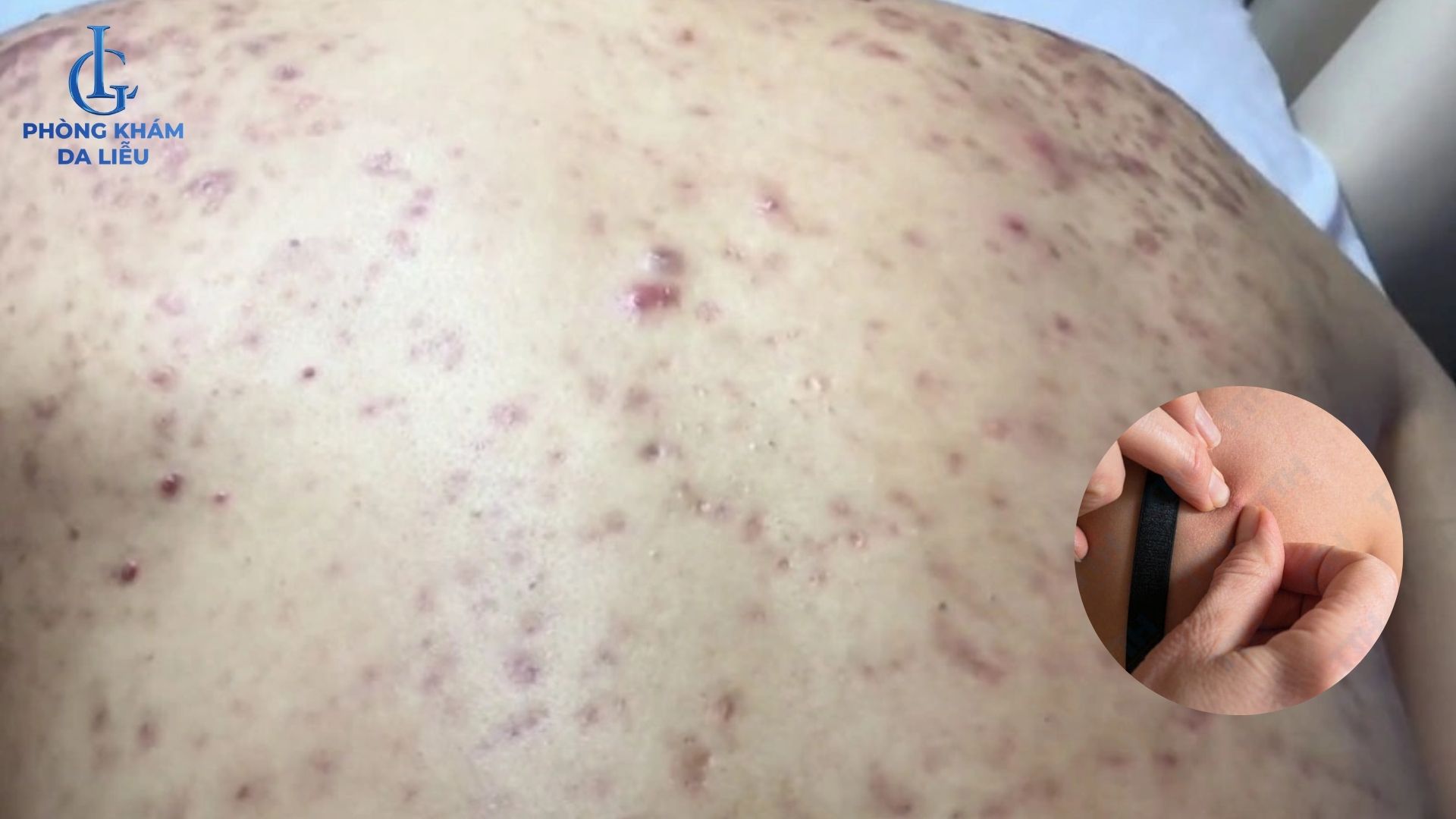 nhiễm trùng da vùng lưng