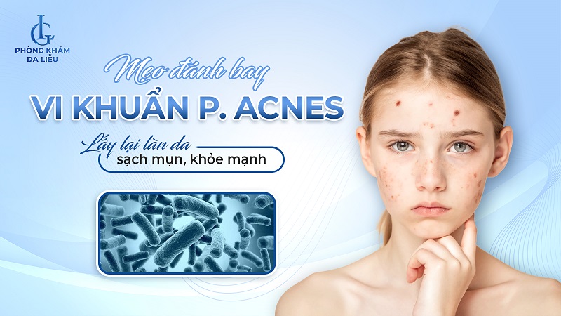 vi khuẩn p acnes