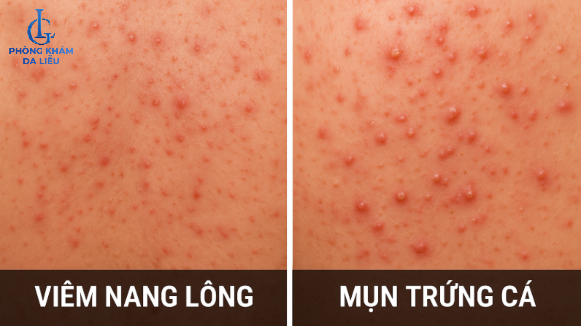 viêm nang lông khác mụn trứng cá