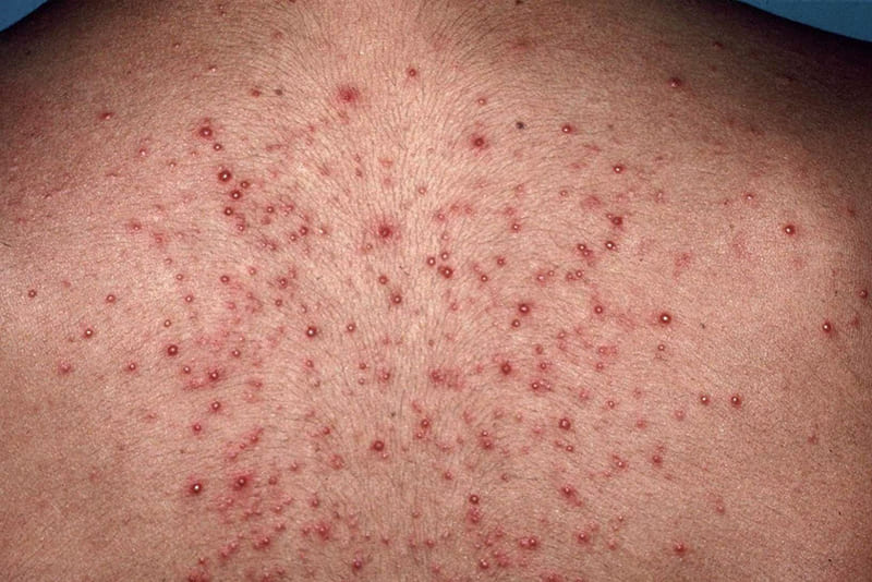 Hình ảnh viêm nang lông ở lưng