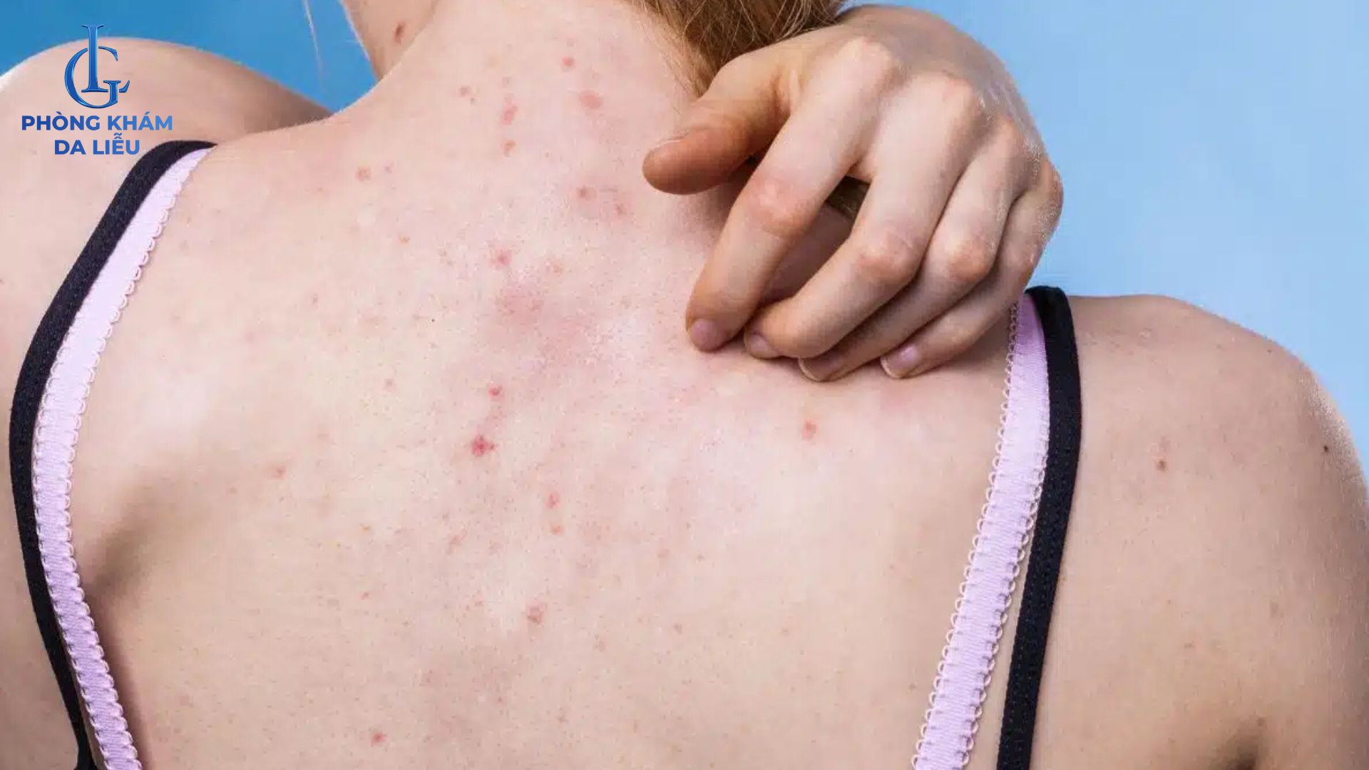 viêm nang lông ở lưng nông