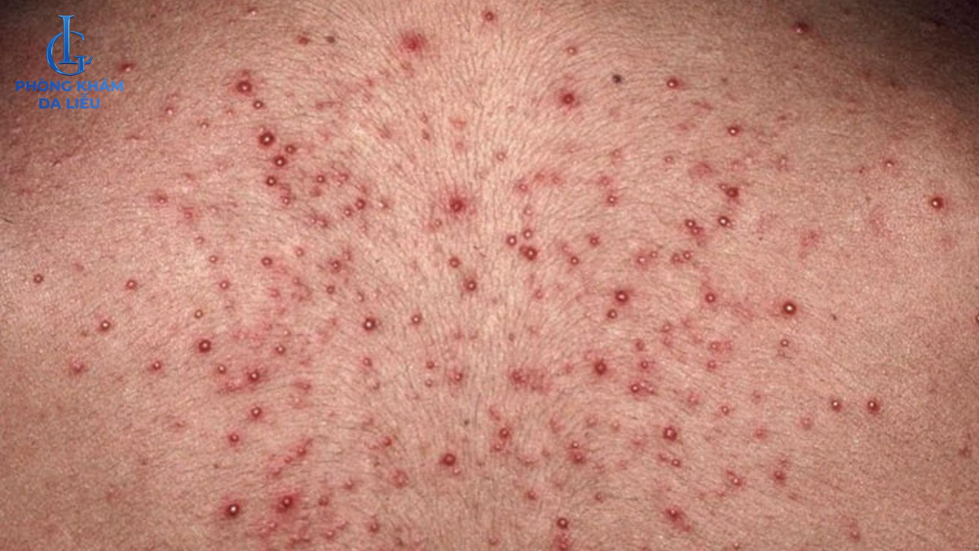 trị viêm nang lông ở lưng sâu