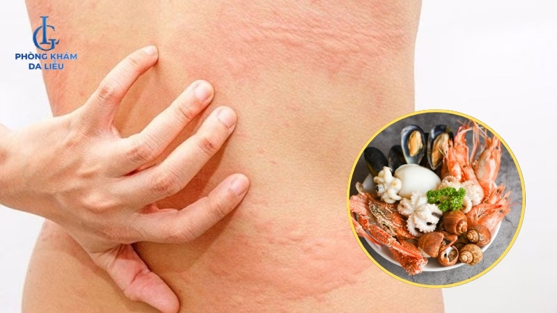 Không nên ăn trứng cá nếu bạn dị ứng với hải sản