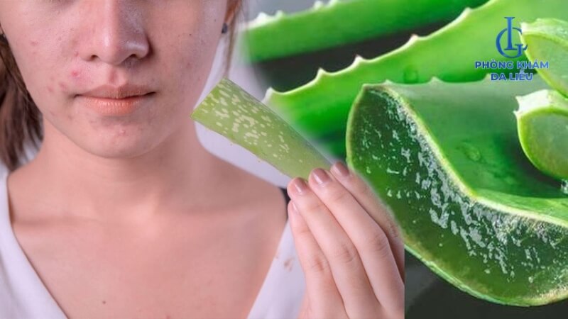 Cách trị mụn bằng nha đam tại nhà