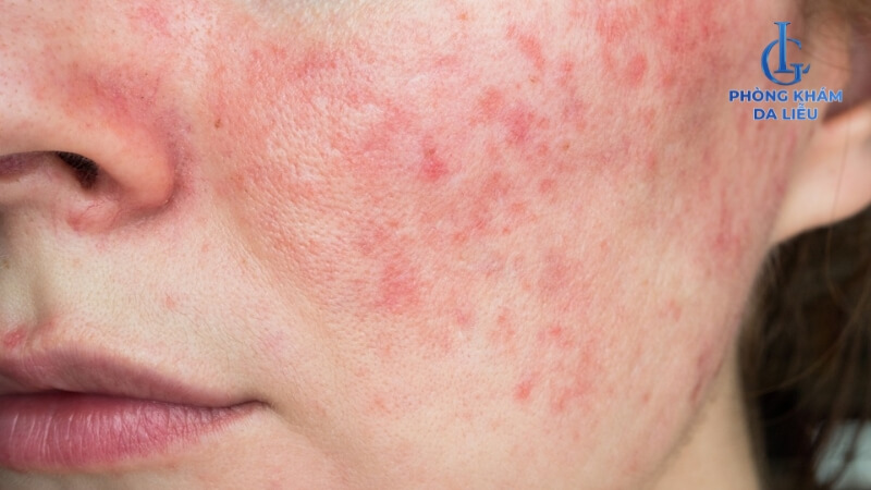 Da nhiễm corticoid cấp độ 3