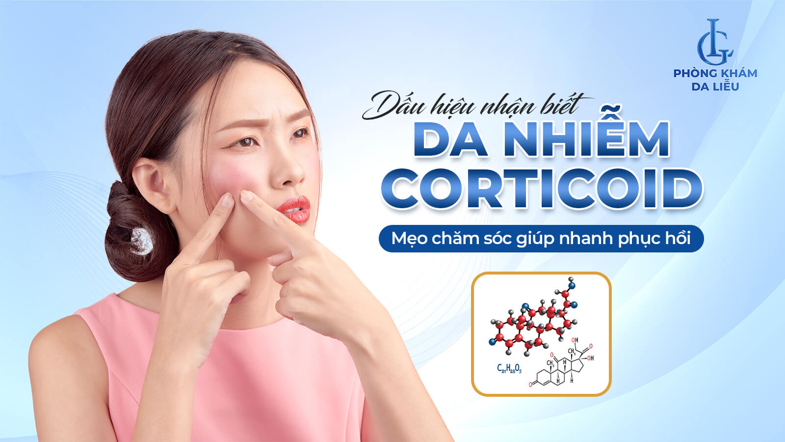 Da nhiễm Corticoid