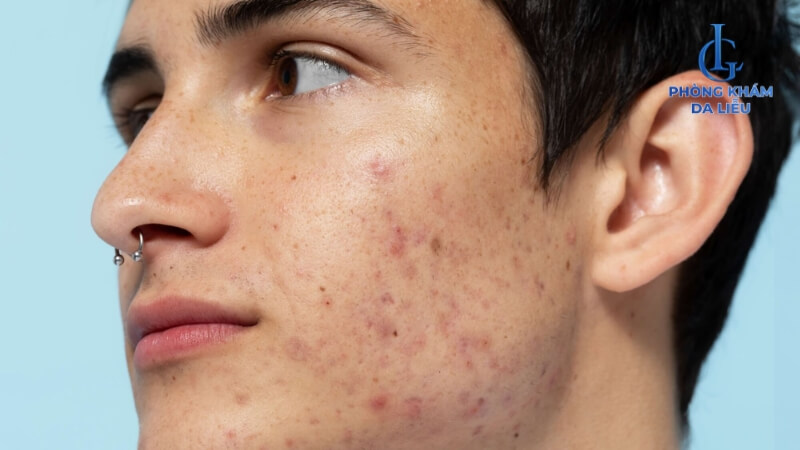 Mụn dị ứng sau khi sử dụng kem chống nắng
