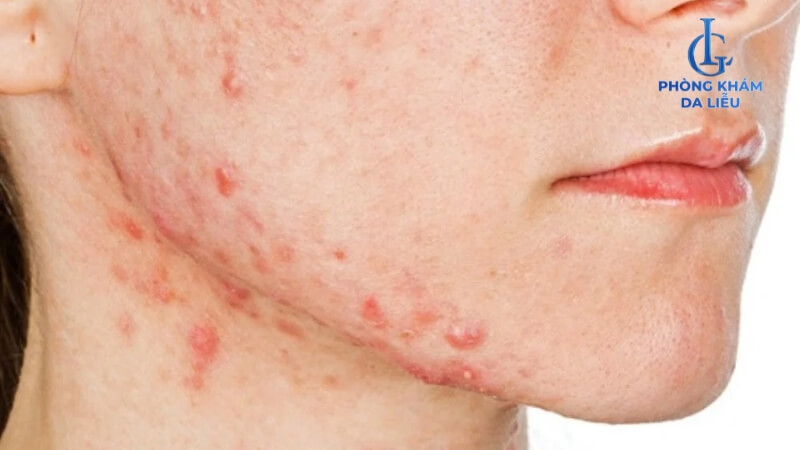 Mụn mọc do dị ứng mỹ phẩm