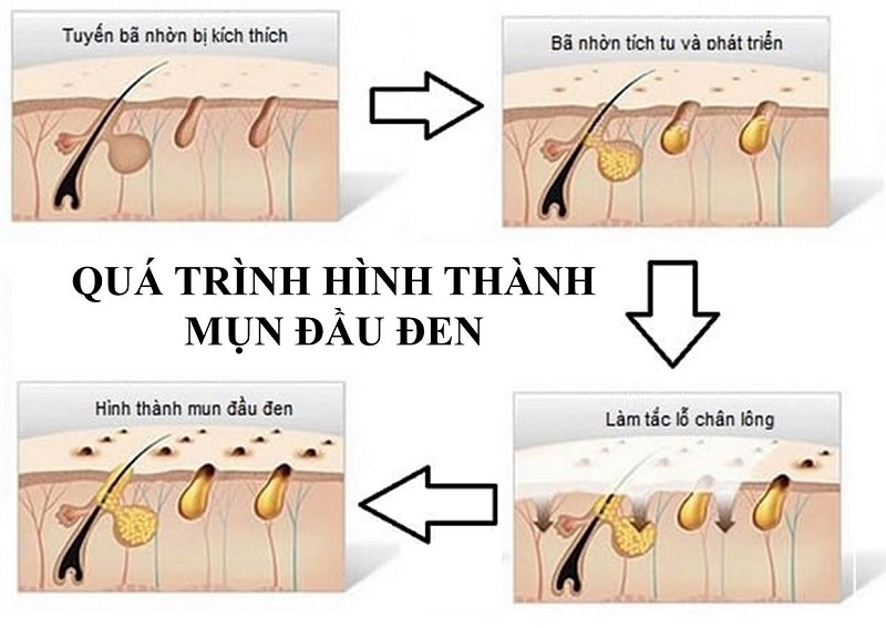 quá trình hình thành mụn