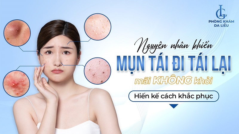 mụn tái đi tái lại