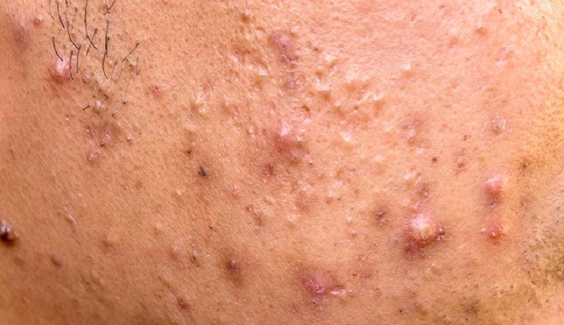 các loại mụn viêm
