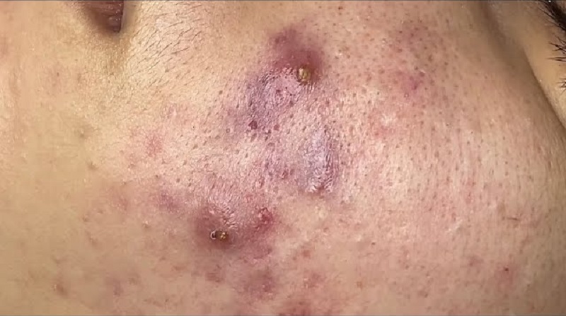 mụn bị tụ máu bầm