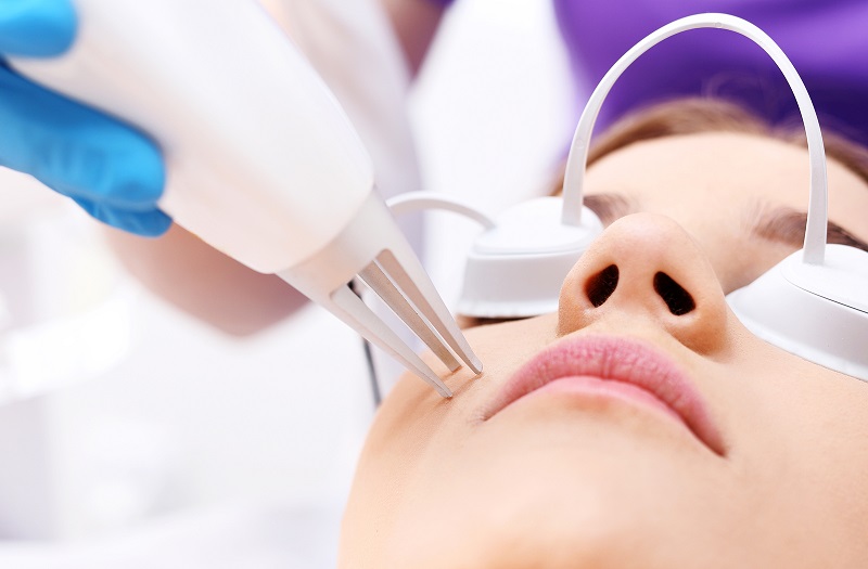 laser trị mụn