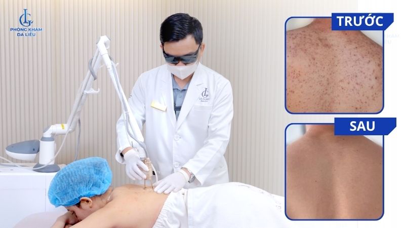 Điều trị mụn lưng