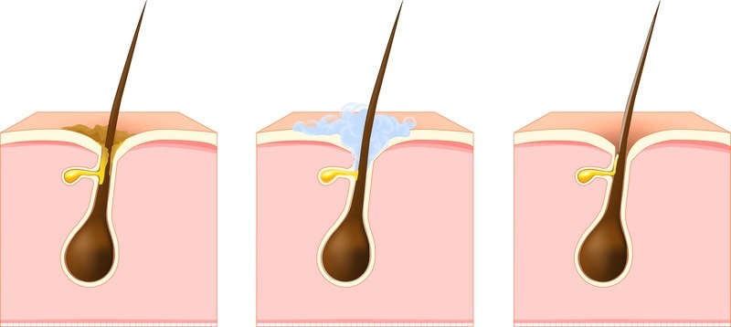 bít tắc lỗ chân lông