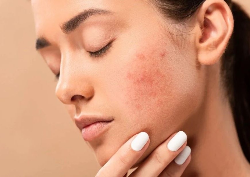 mặt nổi mụn