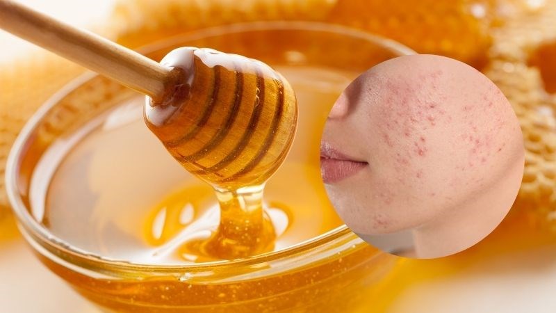 cách trị mụn bằng mật ong sau 1 đêm