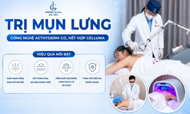Trị mụn Bình Dương