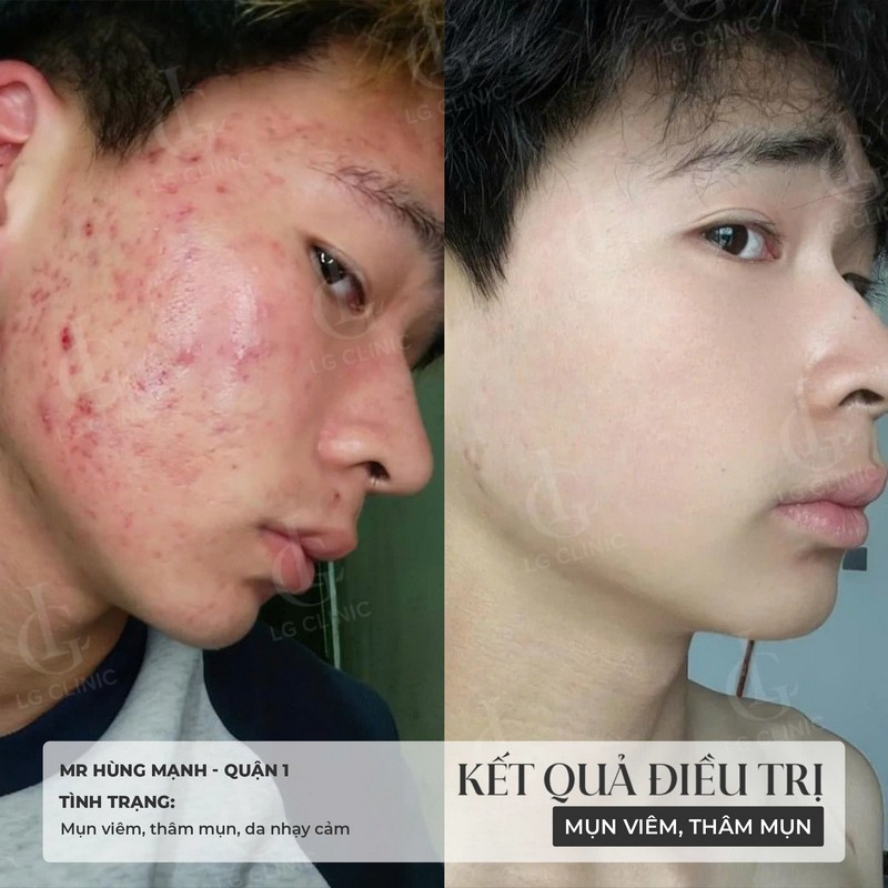 hình trị mụn 1