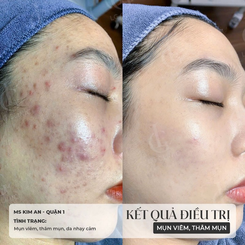 hình trị mụn 2