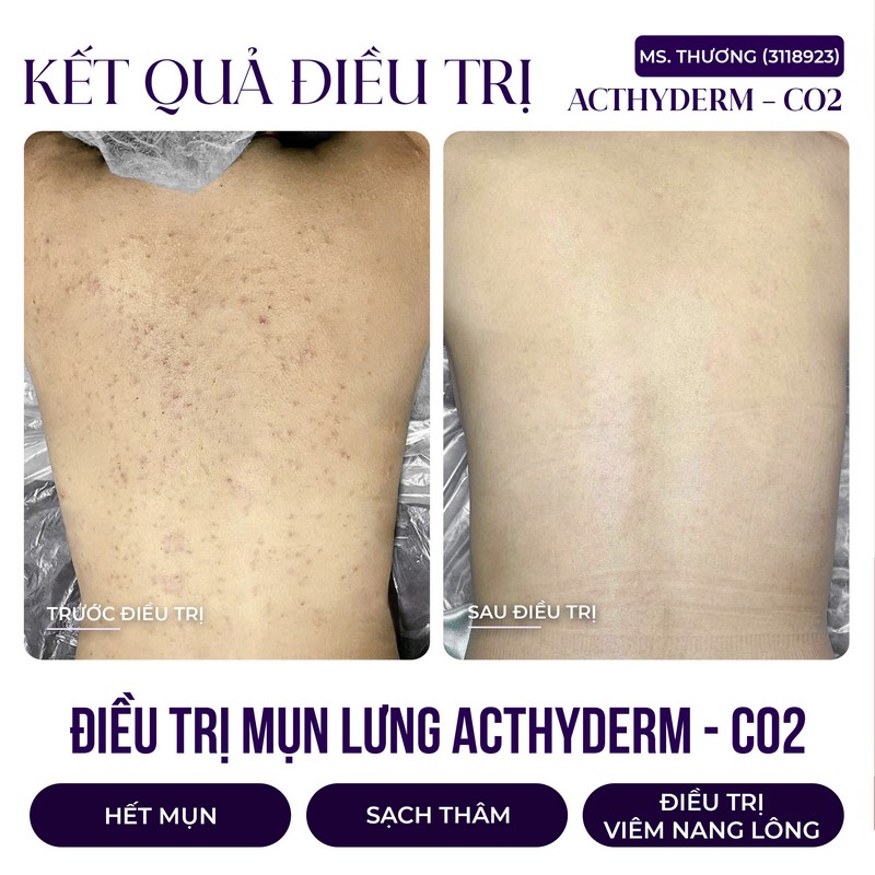 hình trị mụn 3